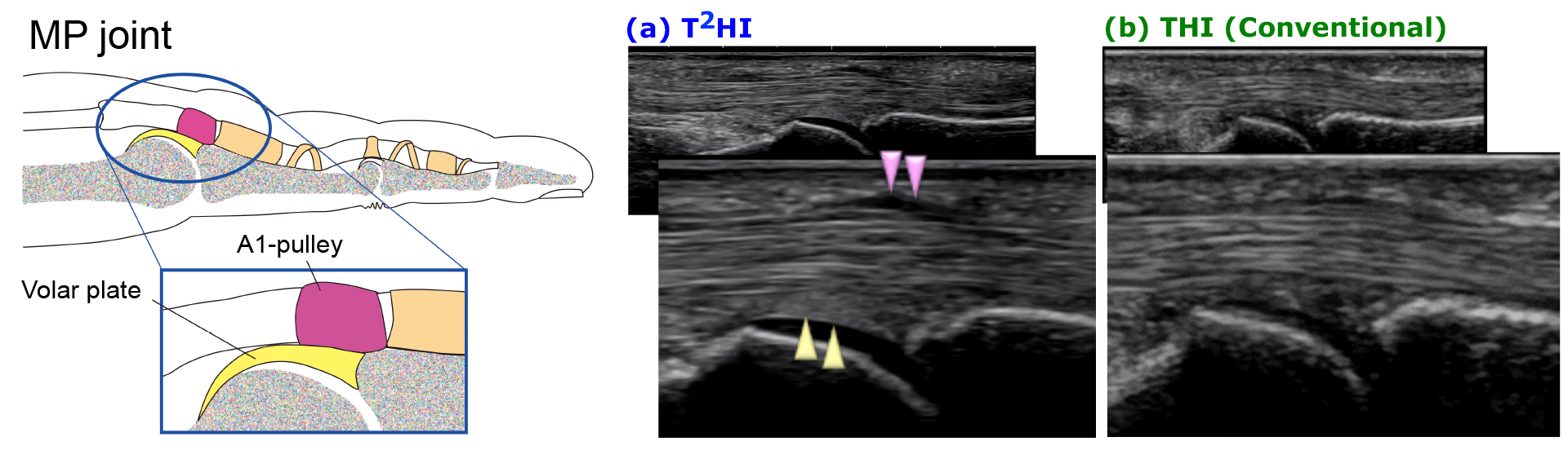 Development of a new technology, T2HI