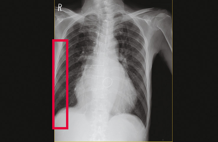 Detection process of images with lung field image deficiency and body movements