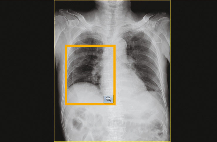 Detection process of images with lung field image deficiency and body movements