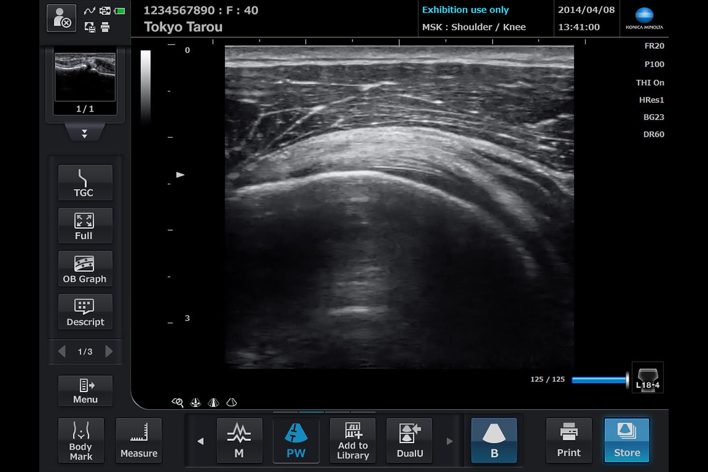 超音波診断装置 SONIMAGE HS1の画面の写真です。