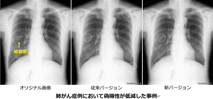 肺がん症例において偽陽性が低減した事例の写真