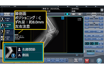 AIで整形領域のX線撮影をサポートするポジショニング判定支援機能「Positioning i」