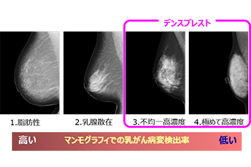 一人ひとりにとって乳がん検診をよりよいものに
